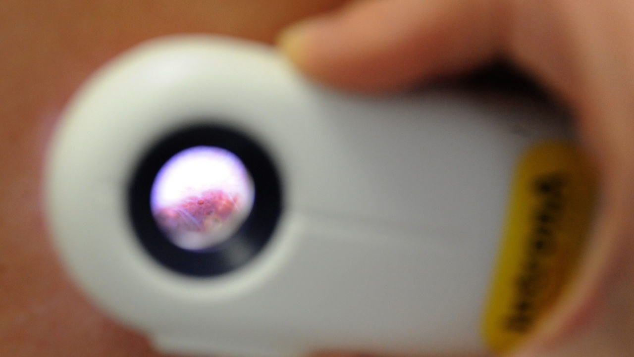 Fontos évente ellenőriztetni az anyajegyeket